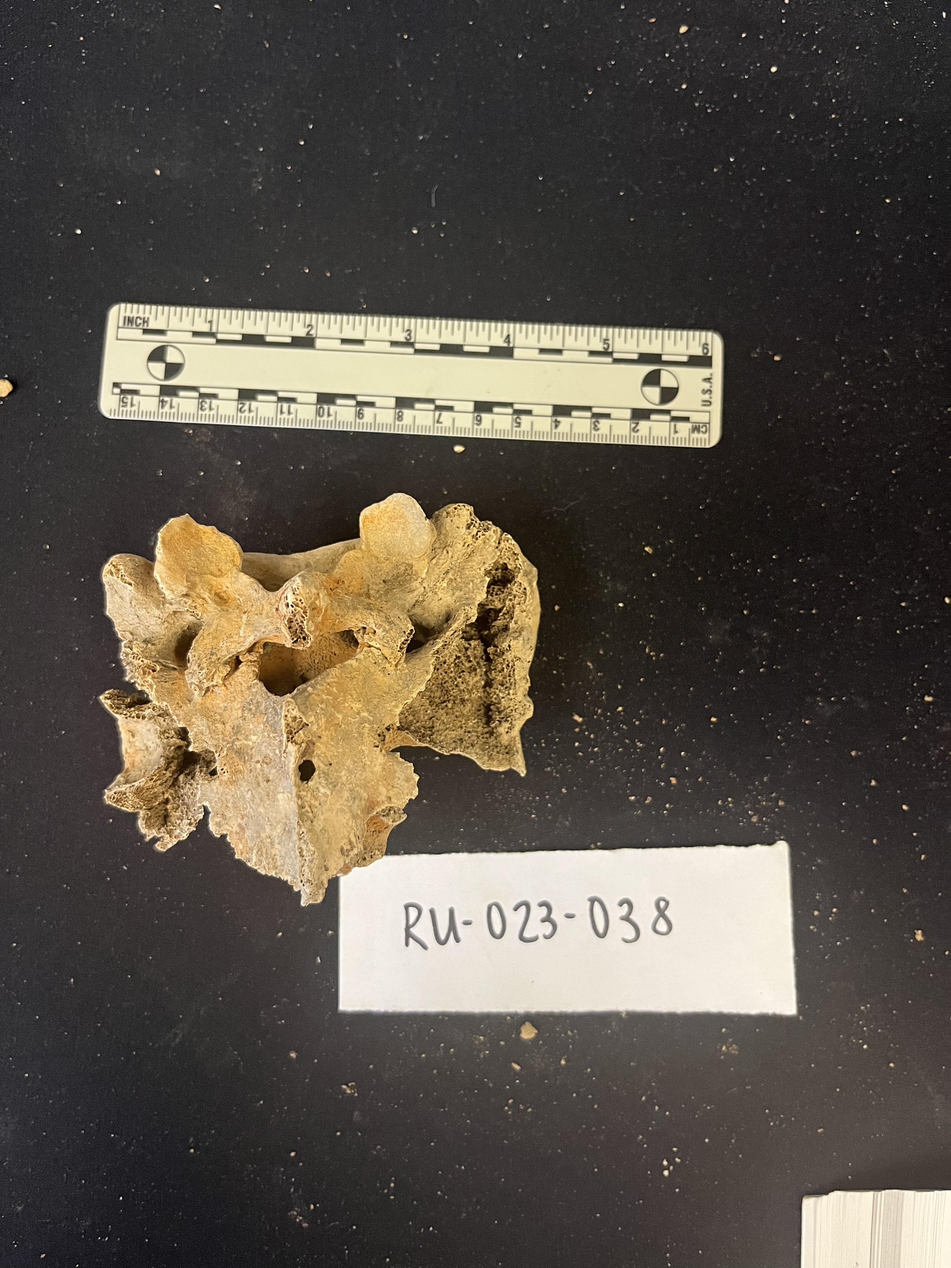 sacrum with L5 fusion