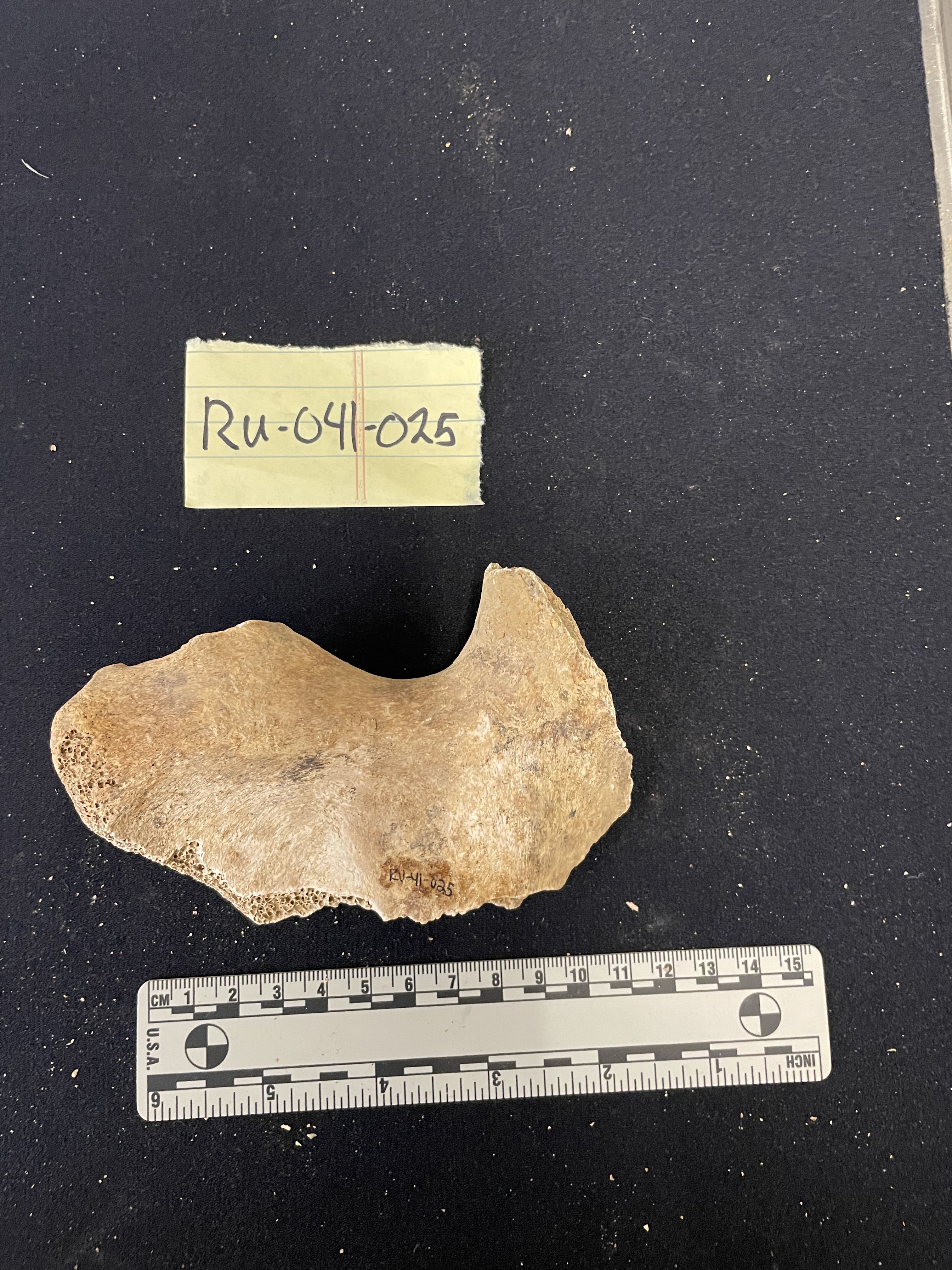 Partial right illium