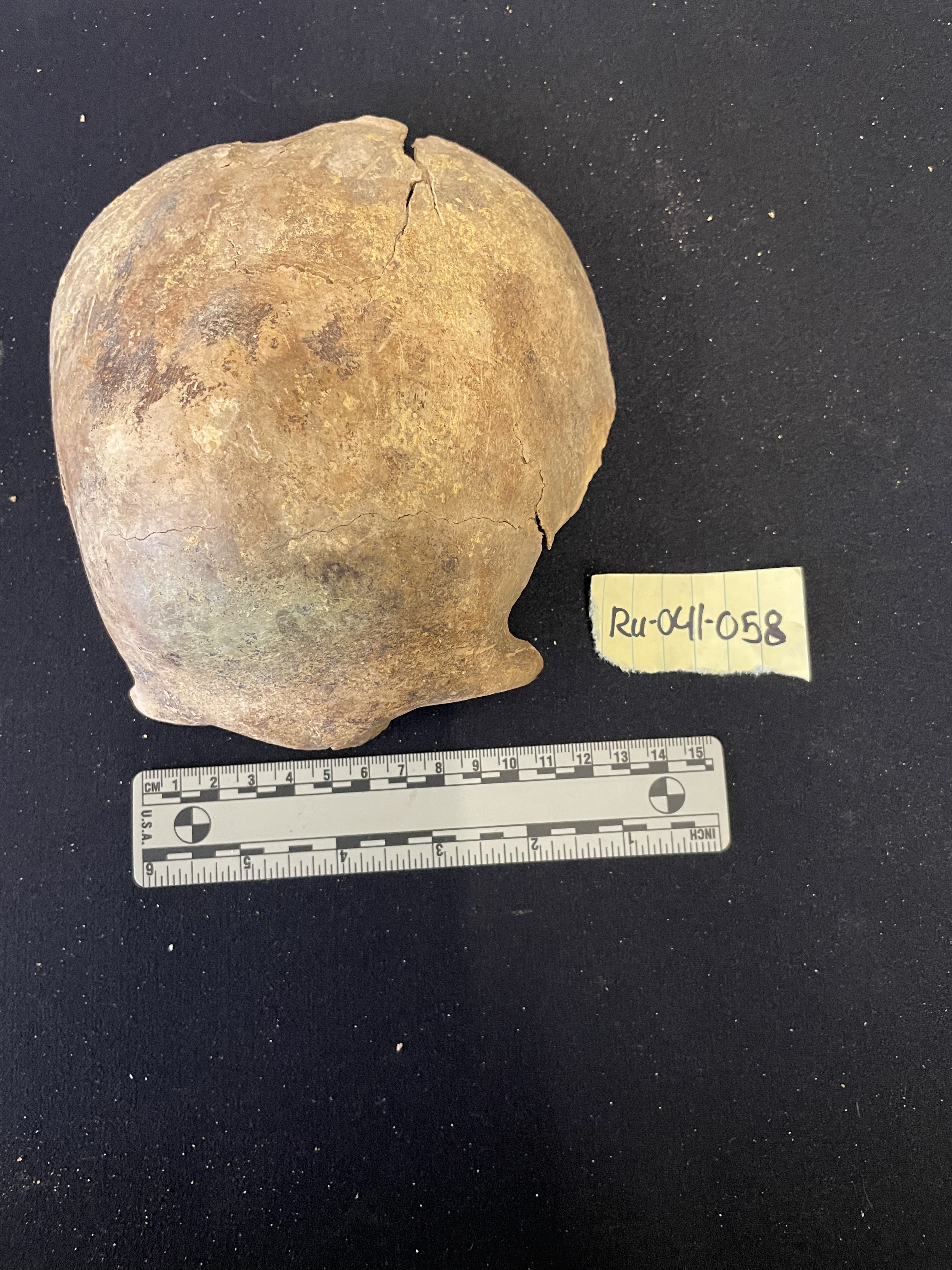 Frontal bone and partial parietal bones showing staining 